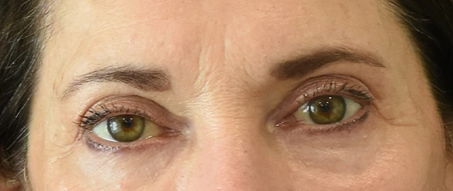 Brow Lift Patient 13 Set 1 After