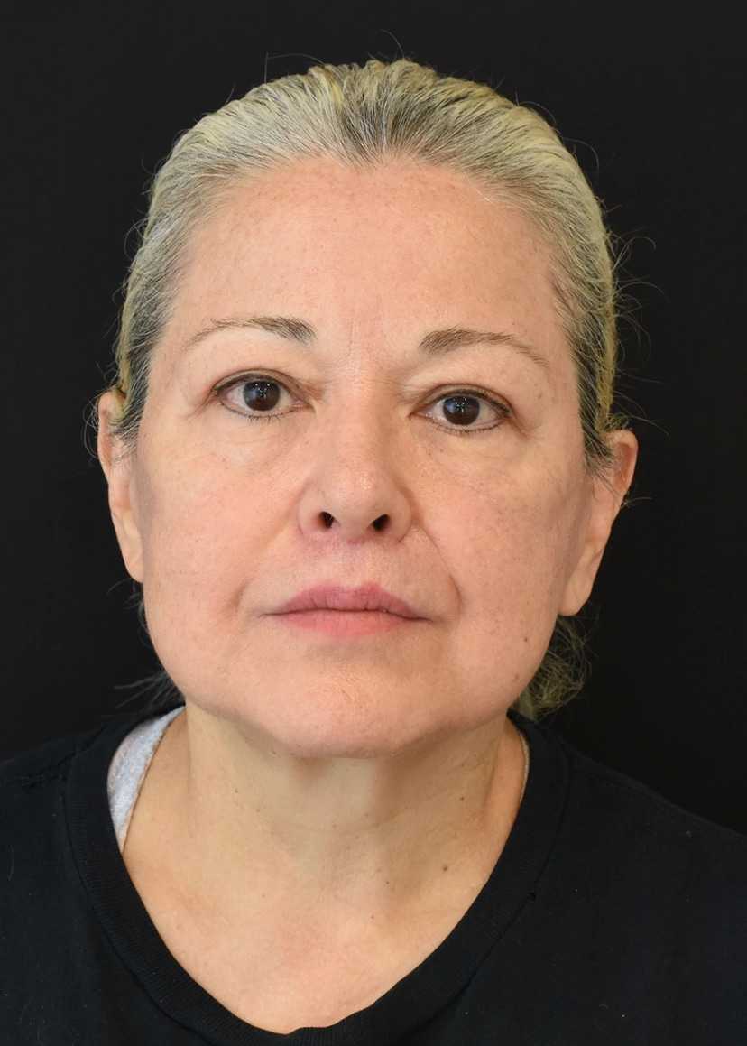 Neck Lift Patient 23 Set 1 After